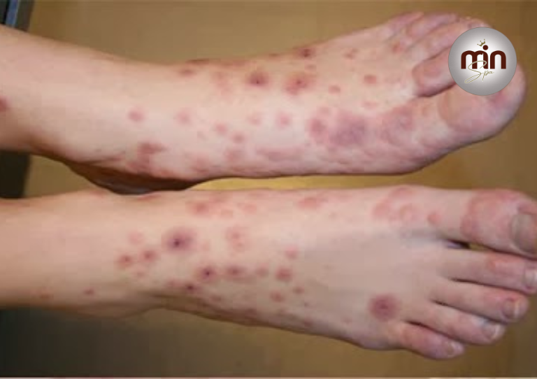 Điều trị thâm tay chân do muỗi đốt, côn trùng cắn 